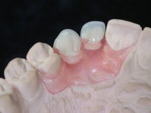 alternativa agli impianti dentali