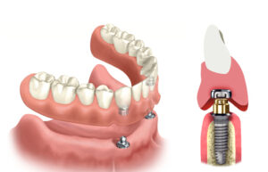 protesi stabilizzata con microimpianti